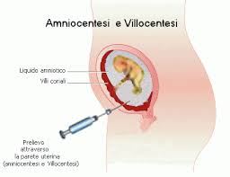 amniocentesi